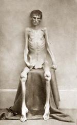Starving Prisoner